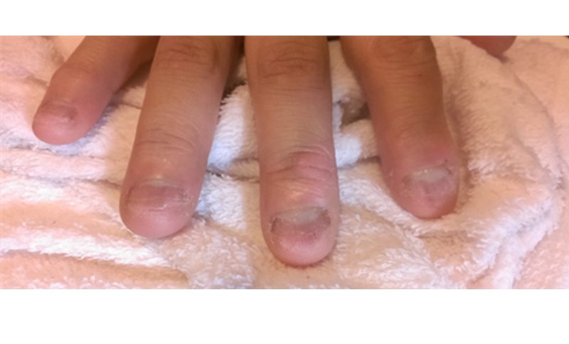 指甲萎縮症是什麼？與灰指甲如何區分？
