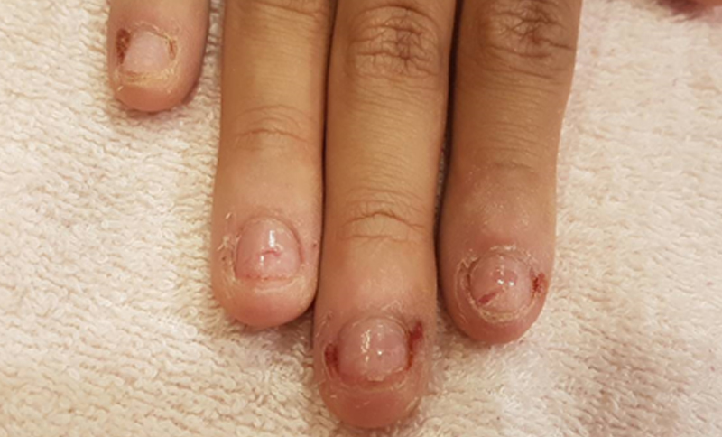 咬甲（Nailbiting）原因、影響與改善方式